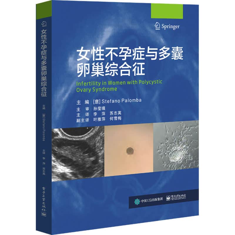 女性不孕症与多囊卵巢综合征